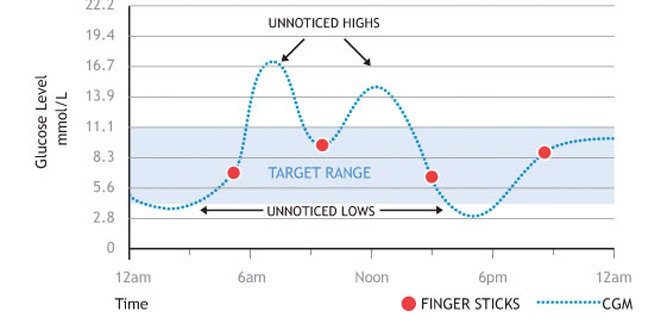 Continuous Glucose Monitoring